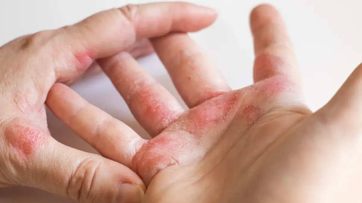 Best Hydrating Cream for Eczema